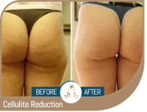 Before and After Gallery of True Laser Spa in Saint Clair Shores, MI