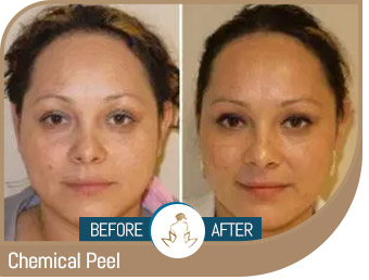 Before and After Gallery of True Laser Spa in Saint Clair Shores, MI