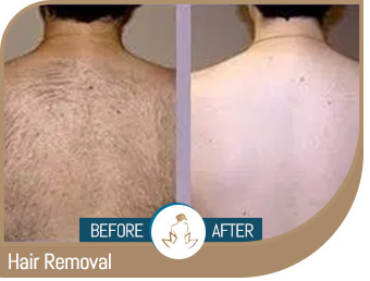 Before and After Gallery of True Laser Spa in Saint Clair Shores, MI