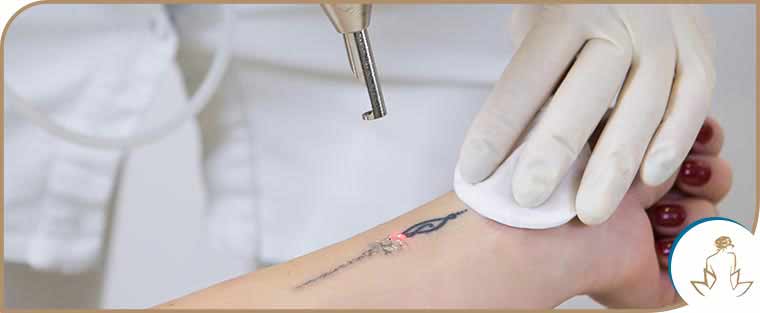 PicoWay Advanced Laser Tattoo Removal  Lakes Dermatology