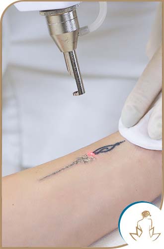 Tattoo Removal Near Me in Saint Clair Shores, MI