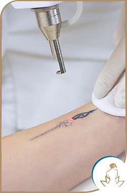 Tattoo Removal Near Me in Saint Clair Shores, MI