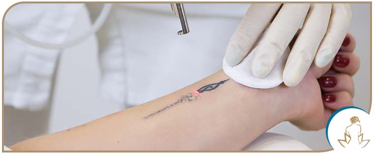 Tattoo Removal Laser  Detroit Plastic Surgery Laser Tattoo Removal