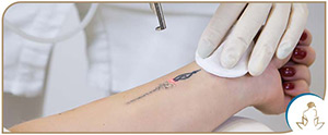 Tattoo Removal Near Me in Saint Clair Shores, MI Tattoo Removal Near Me in Saint Clair Shores, MI