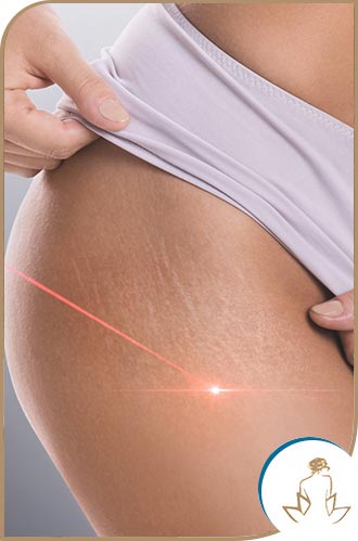 Stretch Marks Removal With Picoway Resolve Laser Near Me in Saint Clair Shores, MI