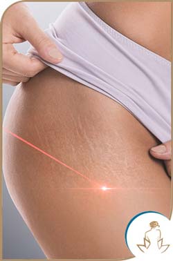Stretch Marks Removal With Picoway Resolve Laser Near Me in Saint Clair Shores, MI