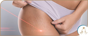 Stretch Marks Removal With Picoway Resolve Laser Near Me in Saint Clair Shores, MI Stretch Marks Removal With Picoway Resolve Laser Near Me in Saint Clair Shores, MI