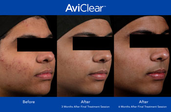 AviClear for Acne Treatment in Saint Clair Shores, MI