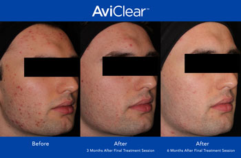 AviClear for Acne Treatment in Saint Clair Shores, MI