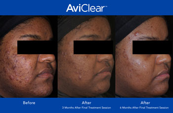 AviClear for Acne Treatment in Saint Clair Shores, MI