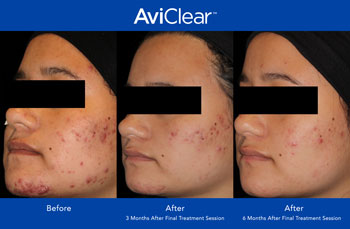 AviClear for Acne Treatment in Saint Clair Shores, MI