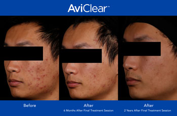 AviClear for Acne Treatment in Saint Clair Shores, MI