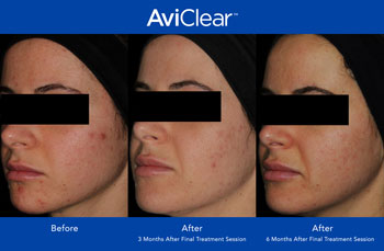 AviClear for Acne Treatment in Saint Clair Shores, MI