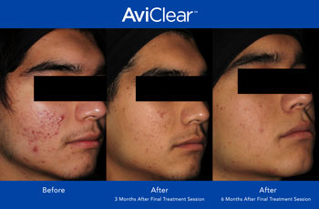 AviClear for Acne Treatment in Saint Clair Shores, MI