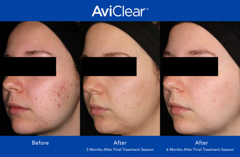 AviClear for Acne Treatment in Saint Clair Shores, MI