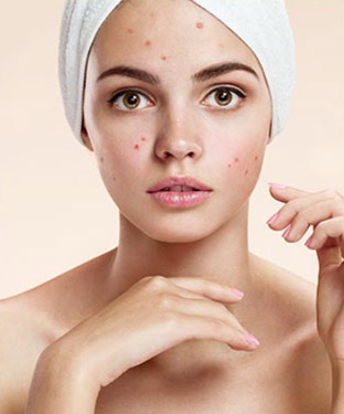 AviClear for Acne Treatment in Saint Clair Shores, MI