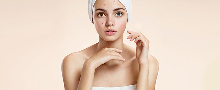 AviClear for Acne Treatment Near Me in Saint Clair Shores, MI