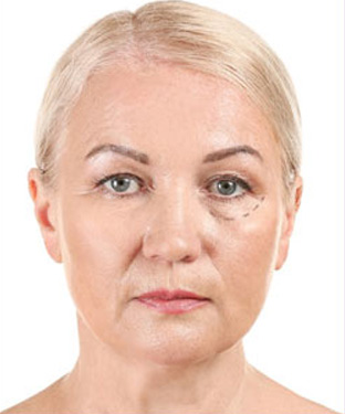 IPL Laser Treatment in Saint Clair Shores, MI