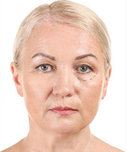 IPL Laser Treatment in Saint Clair Shores, MI