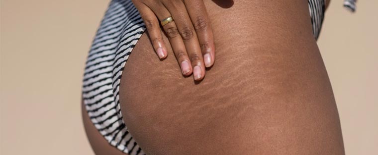 Picoway Resolve Laser for Stretch Marks Near me in Saint Clair Shores MI Picoway Resolve Laser for Stretch Marks Near me in Saint Clair Shores MI