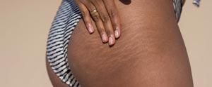 Picoway Resolve Laser for Stretch Marks Near me in Saint Clair Shores MI Picoway Resolve Laser for Stretch Marks Near me in Saint Clair Shores MI