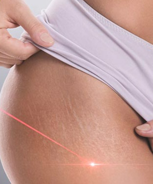 Stretch Marks Removal With Picoway Resolve Laser Near Me in Saint Clair Shores, MI