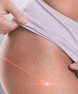 Stretch Marks Removal With Picoway Resolve Laser Near Me in Saint Clair Shores, MI