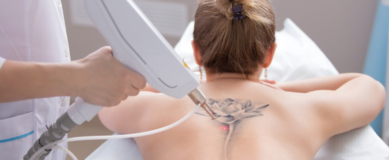 Picoway Laser Tattoo Removal Near Me in Saint Clair Shores, MI