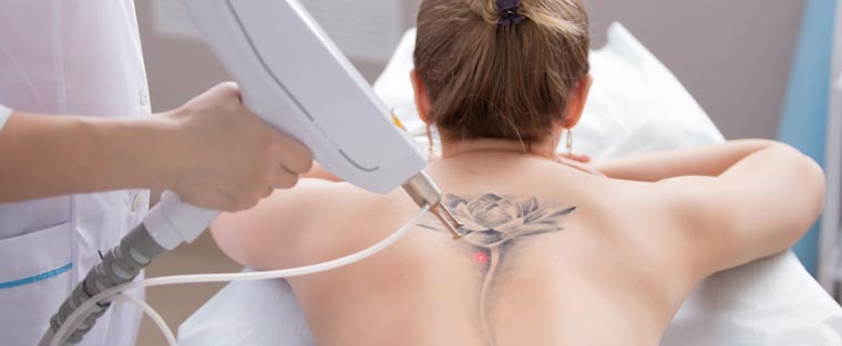 Laser Tattoo Removal Near Me in Saint Clair Shores, MI 