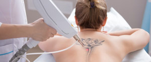 Picoway Laser Tattoo Removal Near Me in Saint Clair Shores, MI