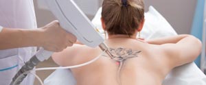 Laser Tattoo Removal Near Me in Saint Clair Shores, MI 