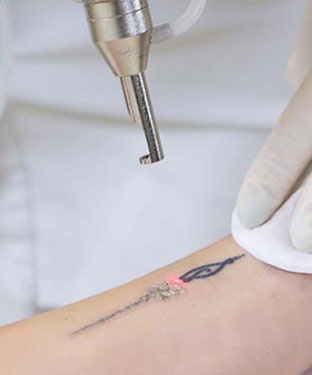 Tattoo Removal Near Me in Saint Clair Shores, MI